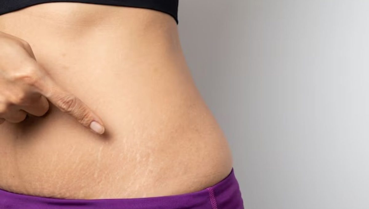 Kulit Lebih Mulus, Ini 5 Cara Alami Mengatasi Stretch Mark yang Patut Dicoba