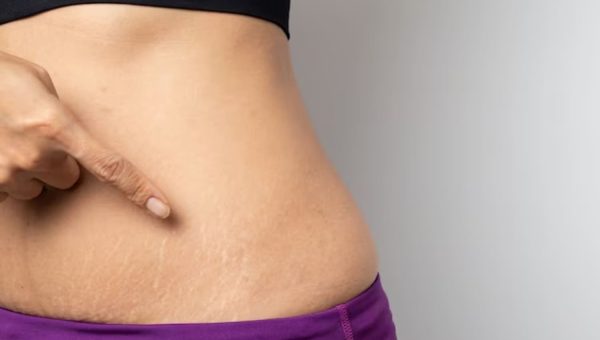 Kulit Lebih Mulus, Ini 5 Cara Alami Mengatasi Stretch Mark yang Patut Dicoba